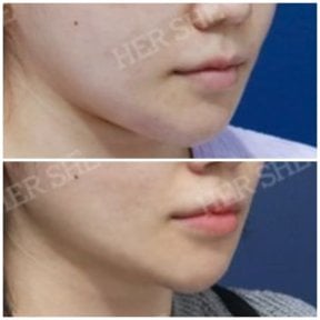 before-after photo liposuction