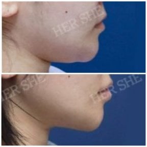 before-after photo liposuction