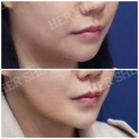 before-after photo liposuction