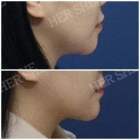before-after photo liposuction