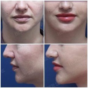 before-after photo tightening-of-facial-skin-facelift