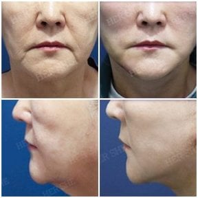 before-after photo tightening-of-facial-skin-facelift