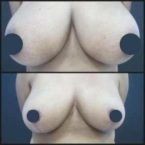 before-after photo breast-reduction