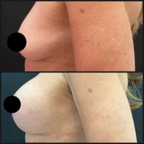 before-after photo mastopexy-breast-lift-contour-plastics