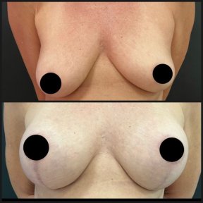 before-after photo mastopexy-breast-lift-contour-plastics