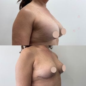 before-after photo breast-implant-removal