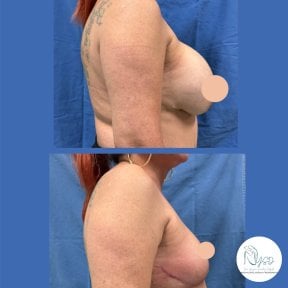 before-after photo breast-implant-removal