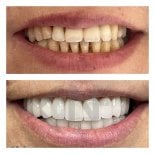 Before and after dental implant results at Nifa Dent International – restored white smile