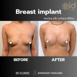 Результаты до и после увеличения груди в ID Clinic Bangkok с имплантами Motiva 400cc