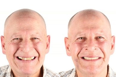 before-after photo implantaciya-zubov-po-tehnologii-all-on-4--vse-na-chetureh