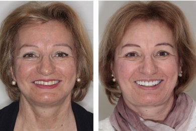 before-after photo implantaciya-zubov-po-tehnologii-all-on-4--vse-na-chetureh