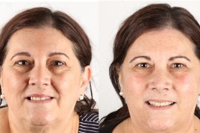 before-after photo implantaciya-zubov-po-tehnologii-all-on-4--vse-na-chetureh