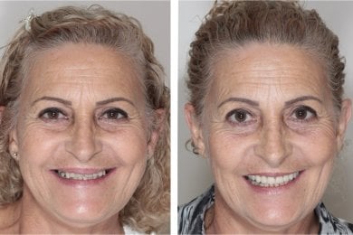 before-after photo immediate-all-on-4-dental-implants