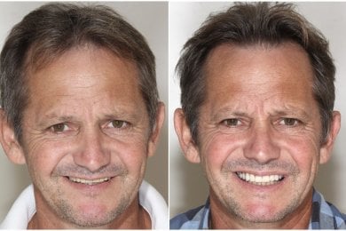 before-after photo immediate-all-on-4-dental-implants
