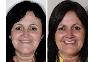 before-after photo zygomatic-implant