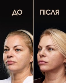 before-after photo blepharoplasty-eyelid