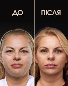 before-after photo blepharoplasty-eyelid