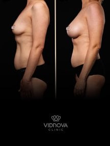 before-after photo breast-augmentation