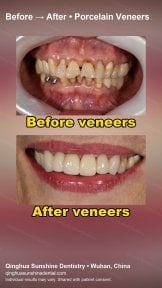 before-after photo wisdom-tooth-removal