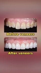 before-after photo wisdom-tooth-removal